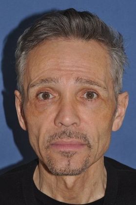 Before facial plastic surgery